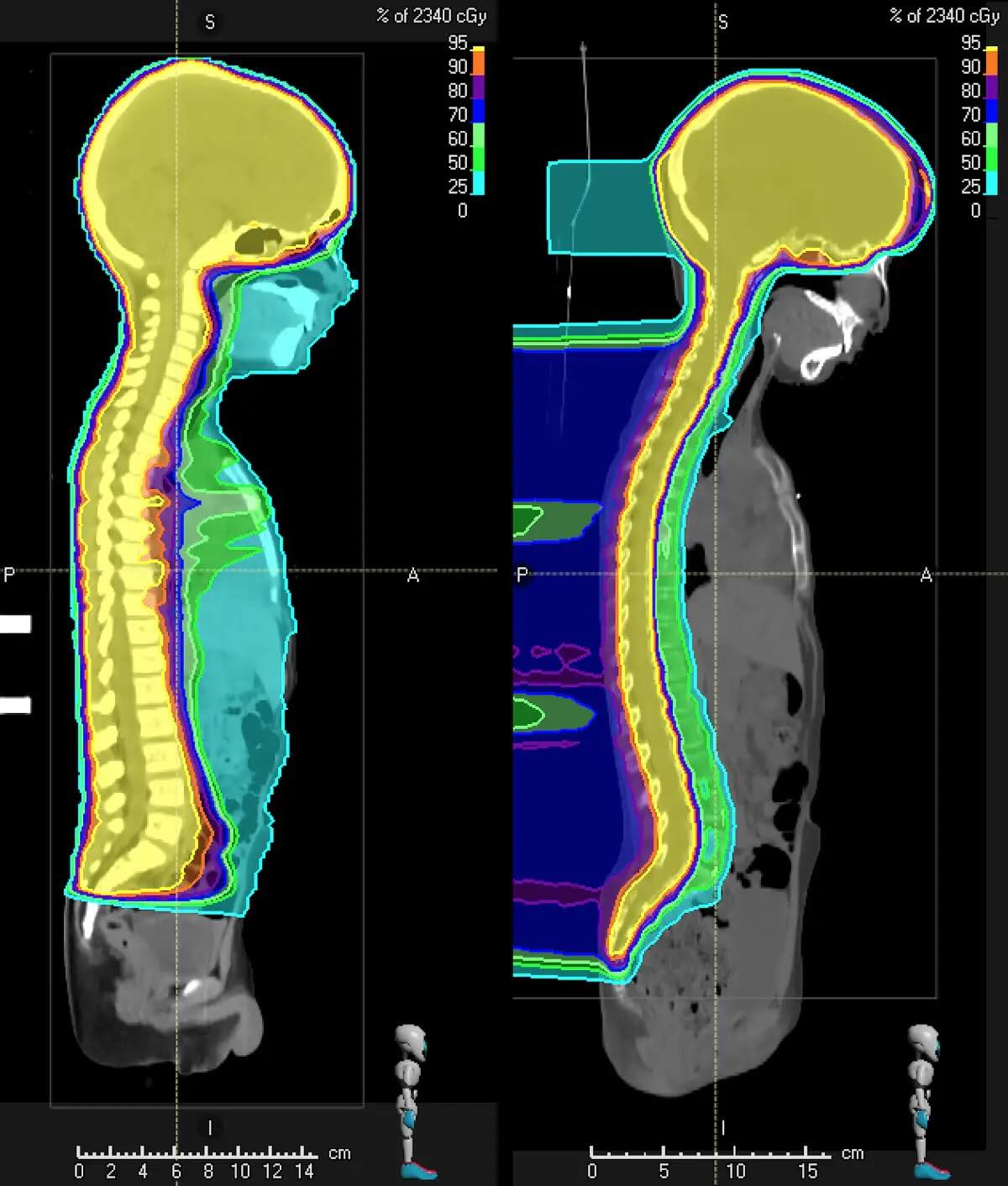 Dose of radiation on children